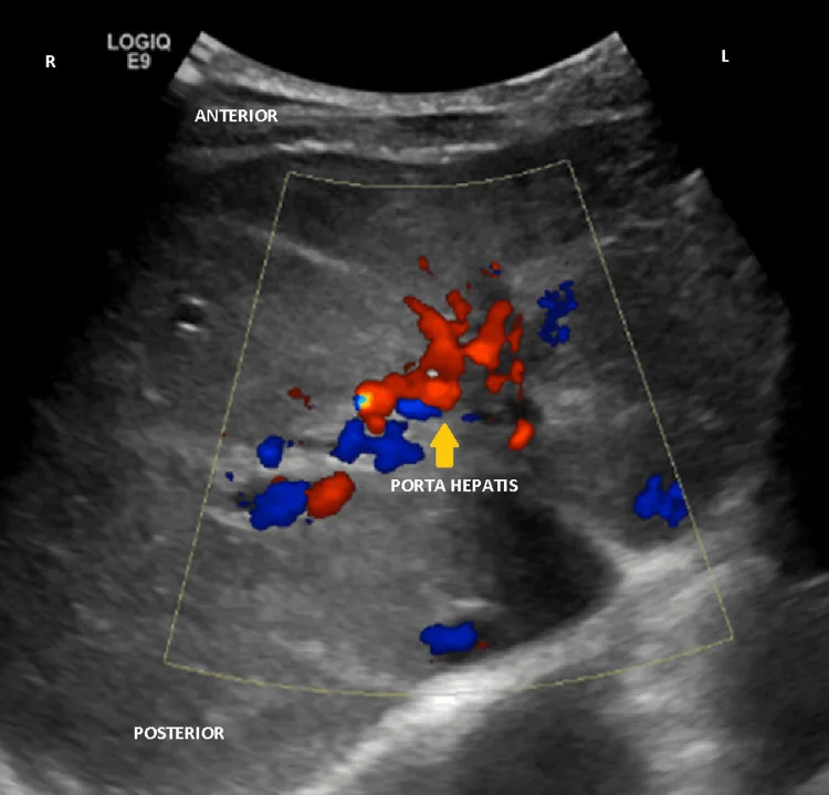 Ecografía Doppler color del hilio hepático con múltiples vasos tortuosos de flujo en rojo y azul alrededor de la porta, propios de un cavernoma portal.