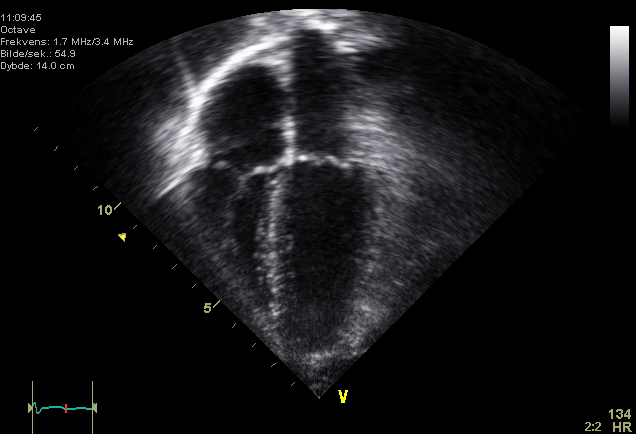 Ecocardiograma: Vista apical de 4 cámaras