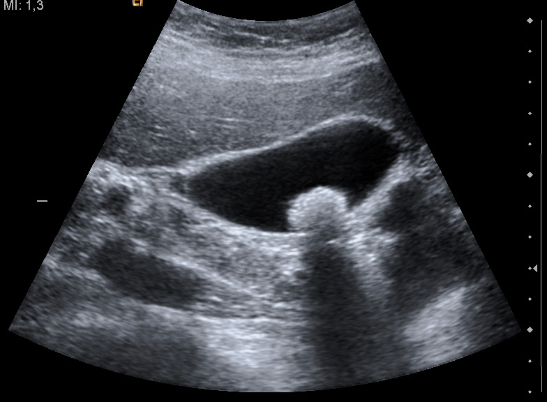 Litiasis vesicular (piedras en la vesícula)