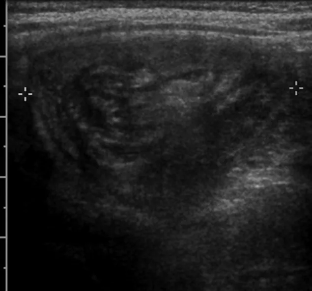 Ecografía abdominal de un niño de 3 años con el signo de la diana: Anillos concéntricos de pared intestinal que corresponden a la invaginación.
