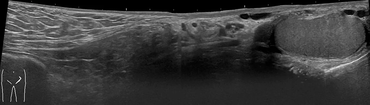 Ecografía longitudinal del conducto inguinal izquierdo de un hombre de 67 años con una hernia inguinal indirecta que contiene grasa y llega hasta el testículo.