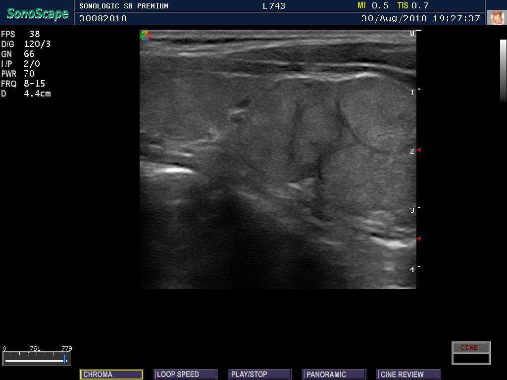 Tiroiditis crónica autoinmunitaria