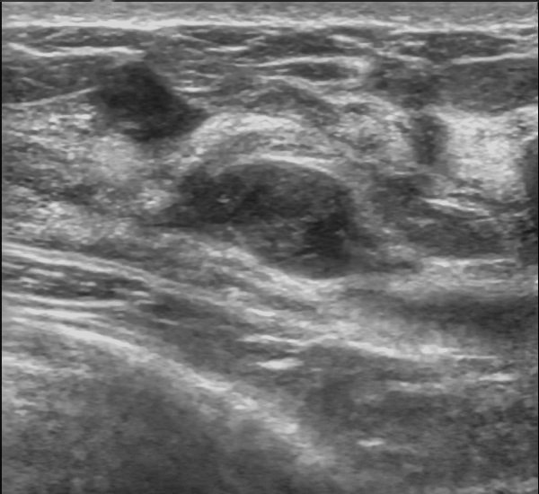 Fibroadenoma