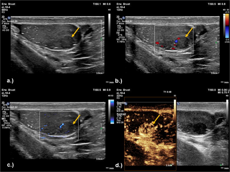 Tumor germinal testicular