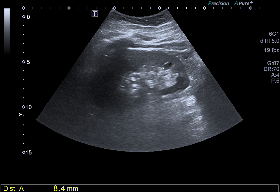 Quiste renal simple
