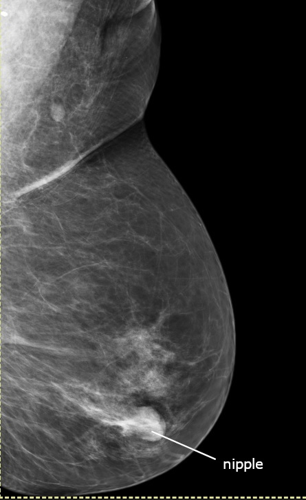 Mamografía normal (proyección oblicua mediolateral)