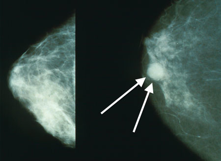 Carcinoma ductal infiltrante