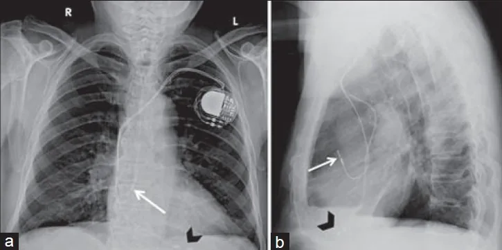 Radiografías de tórax posteroanterior y lateral con un marcapasos bicameral: Generador subcutáneo pectoral izquierdo, cable en la aurícula derecha y cable en el ventrículo derecho.