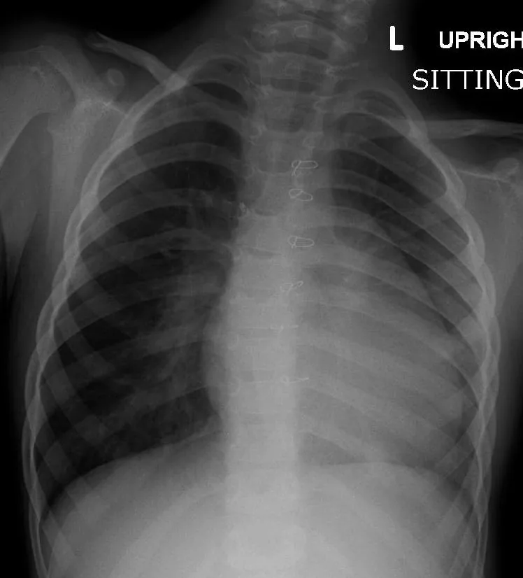 Radiografía de tórax de un niño con tetralogía de Fallot: Silueta cardiaca con la punta elevada y el segmento de la arteria pulmonar cóncavo.
