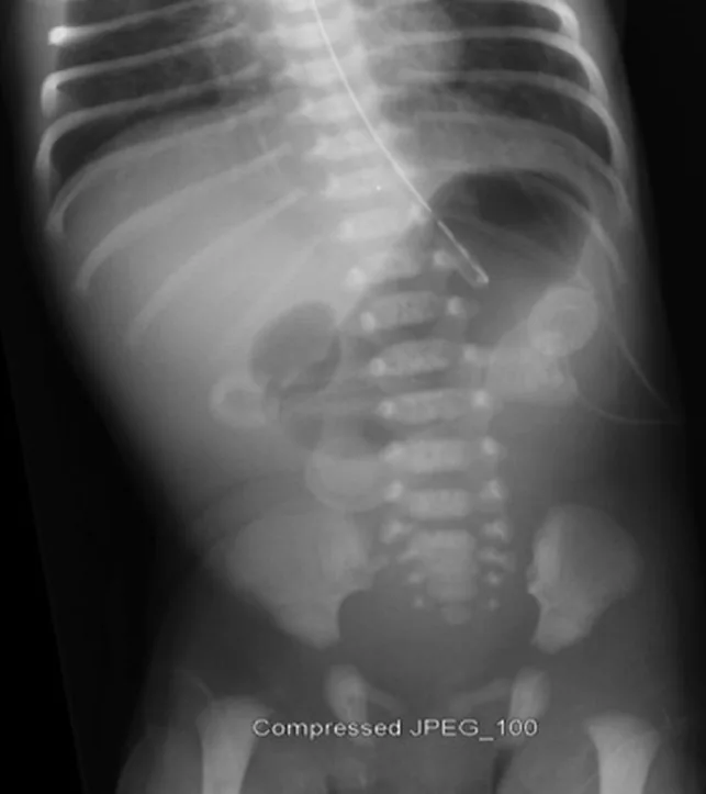 Radiografía de abdomen de un recién nacido con el signo de la doble burbuja: Estómago y bulbo duodenal llenos de aire, con escaso gas distal.