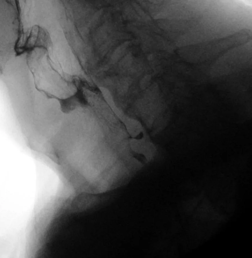 Esofagograma lateral con bario: Pequeña bolsa que protruye hacia atrás en la unión faringoesofágica, por encima del músculo cricofaríngeo.