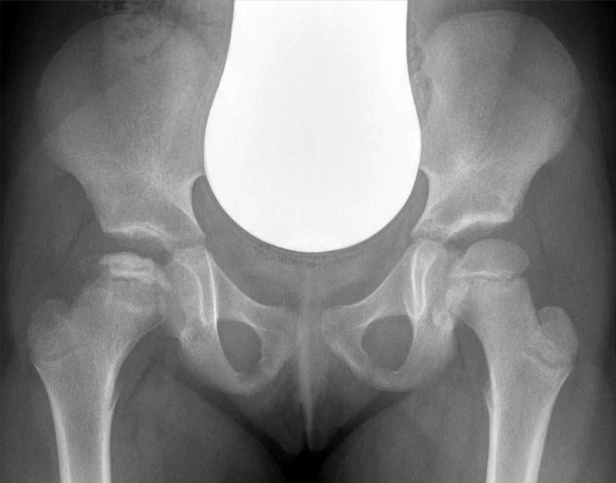 Radiografía anteroposterior de pelvis infantil con la epífisis femoral derecha aplanada, más densa y fragmentada frente a la izquierda normal.