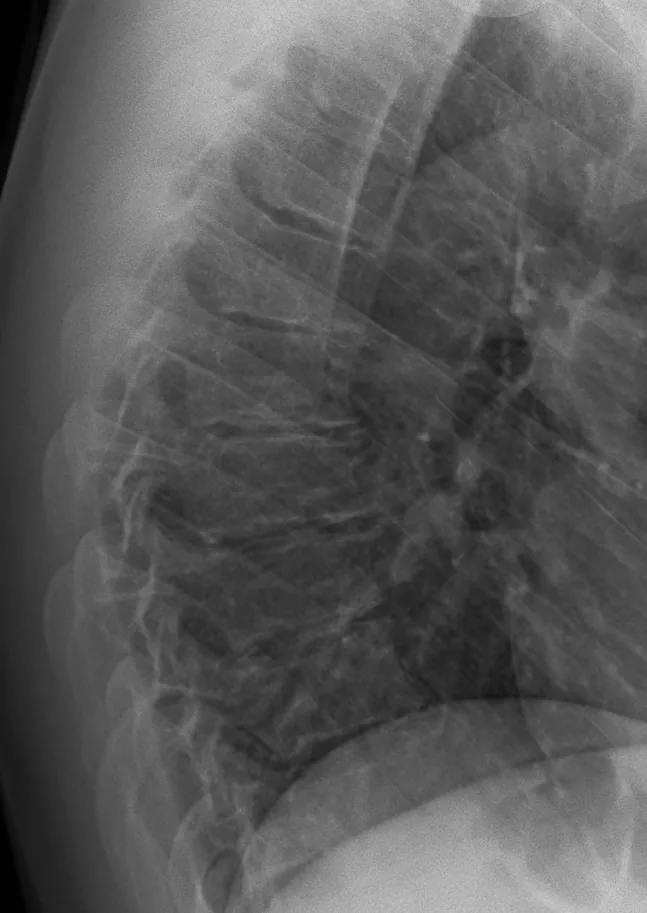 Radiografía lateral de la columna dorsal con acuñamiento anterior de varios cuerpos vertebrales consecutivos, entre T6 y T10, y platillos irregulares.