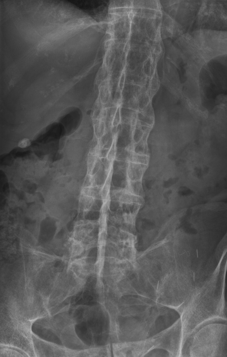 Espondilitis anquilosante