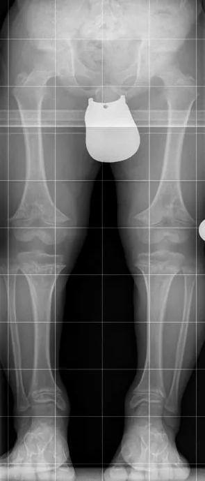 Telerradiografía de miembros inferiores de un niño de 10 años con acondroplasia: Huesos largos cortos y gruesos con metáfisis ensanchadas.