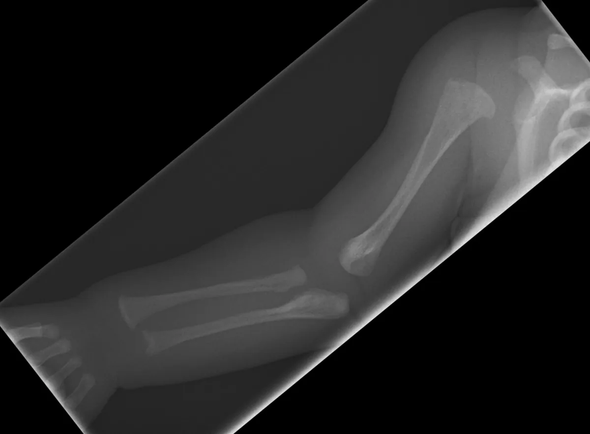 Radiografía del brazo derecho de un recién nacido con osteogénesis imperfecta: Huesos finos y poco densos con deformidad del húmero.