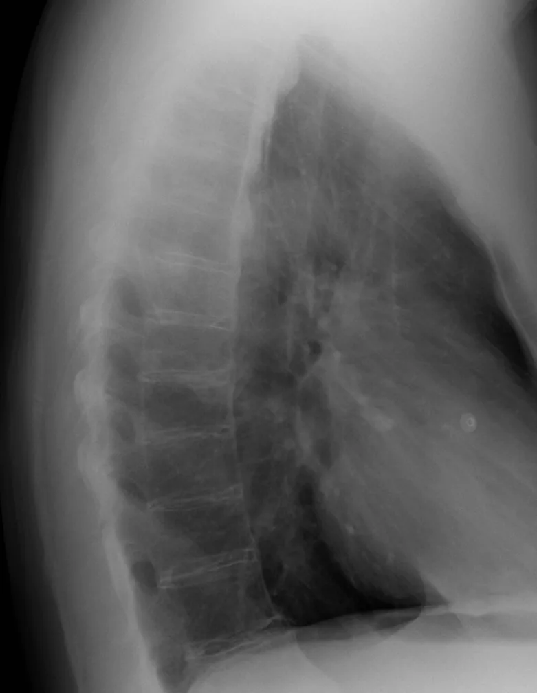 Radiografía lateral de la columna dorsal con osificación gruesa y continua del borde anterior de varios cuerpos vertebrales y discos de altura conservada.