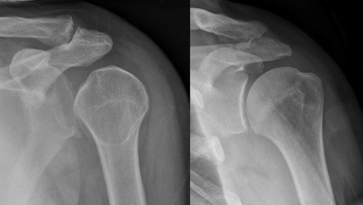 Dos radiografías del hombro: A la izquierda, la cabeza humeral en rotación interna fija con forma de bombilla por la luxación posterior; a la derecha, la articulación tras la reducción.
