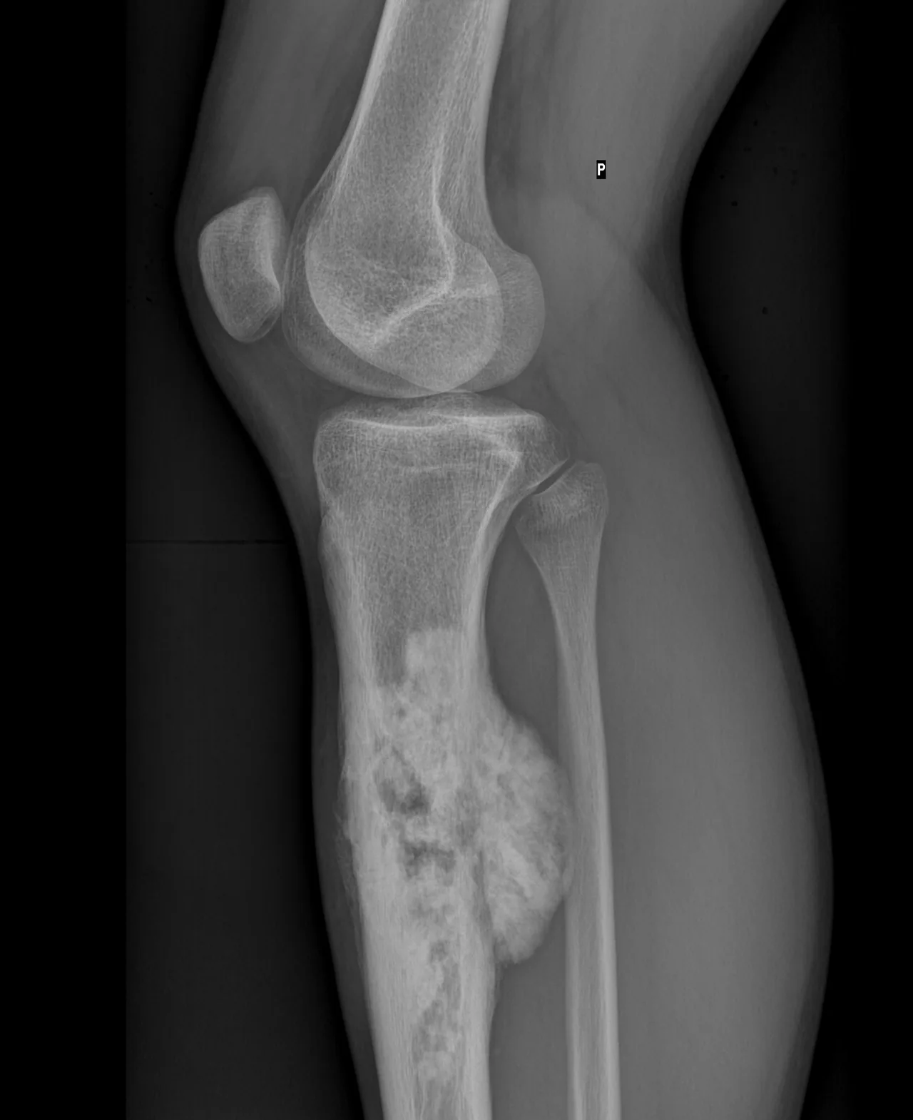 Osteosarcoma
