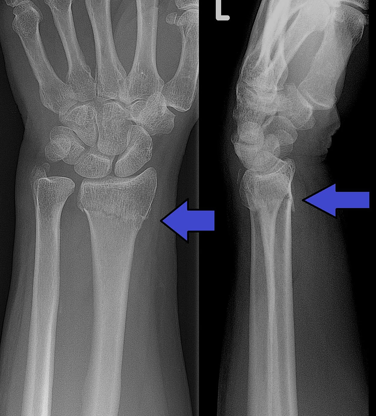 Fractura de Colles (radio distal)