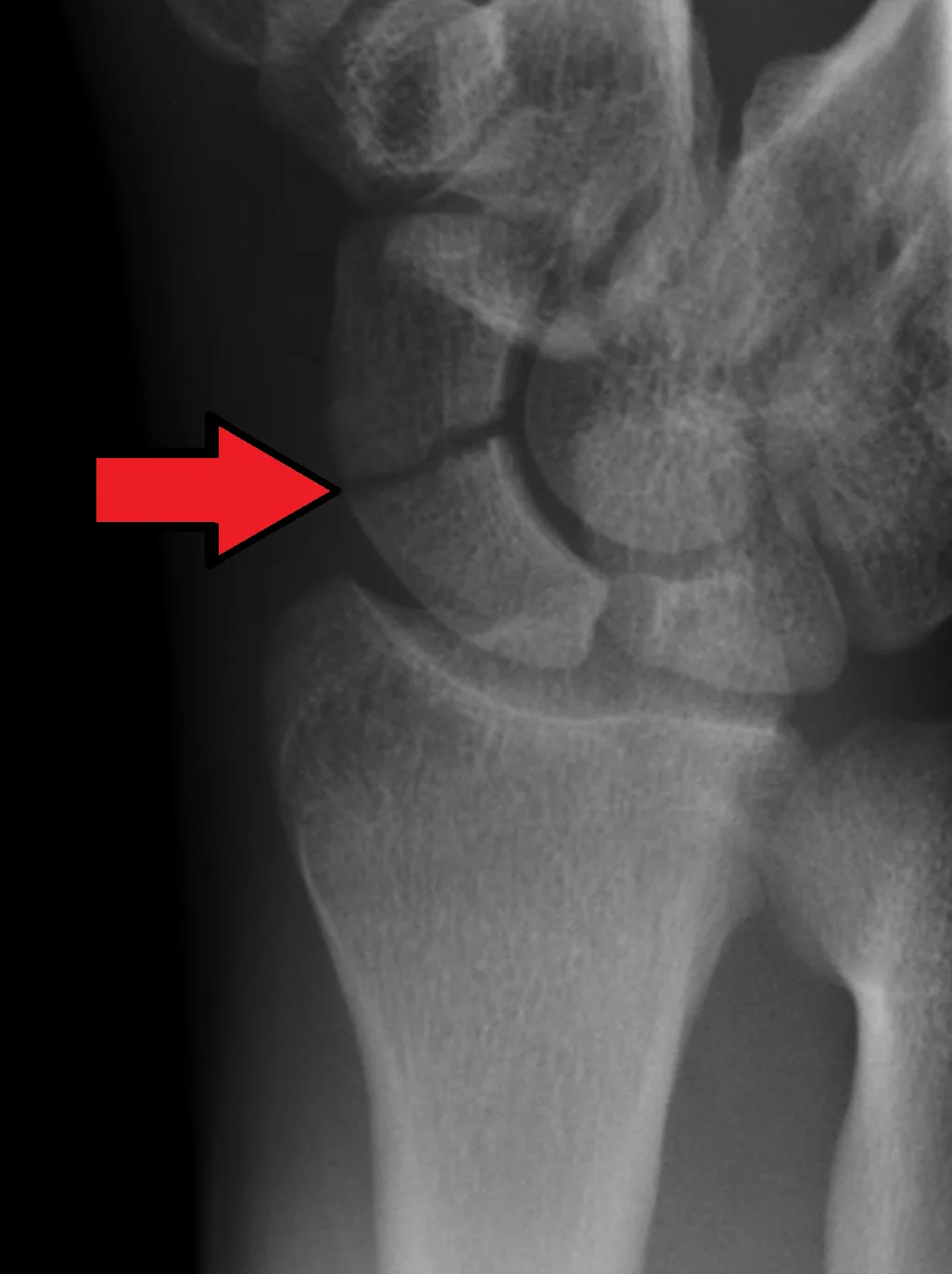 Fractura de escafoides