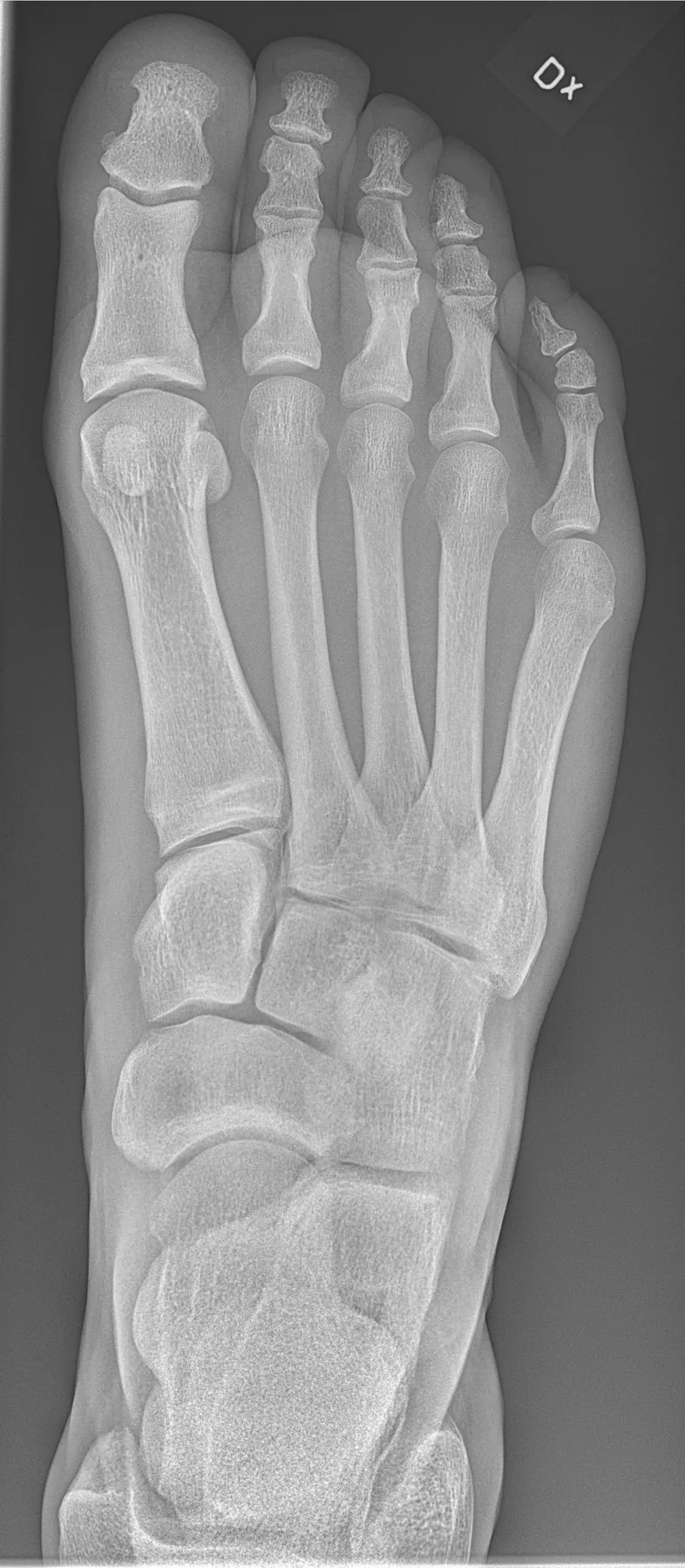 Radiografía de pie normal (dorsoplantar)