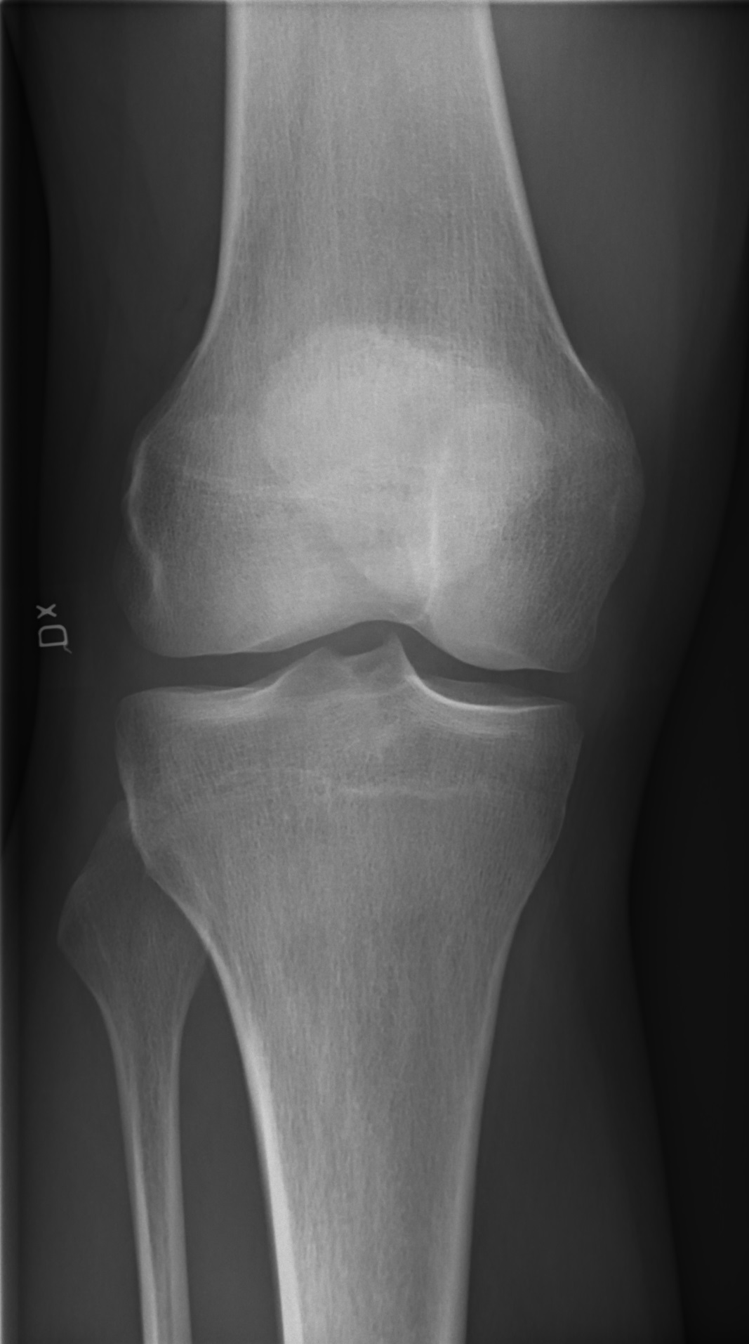 Radiografía de rodilla normal (anteroposterior)
