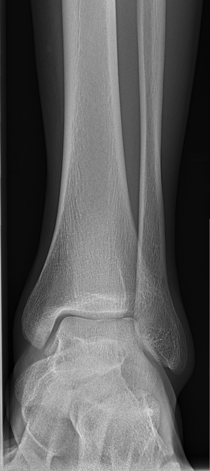Radiografía de tobillo normal (frontal)