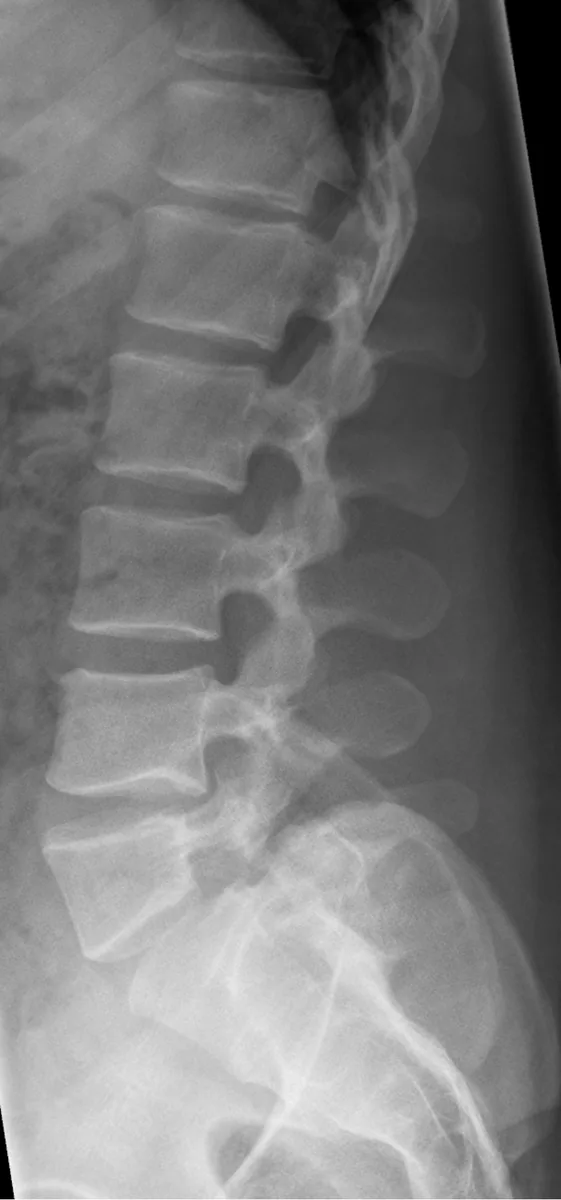 Radiografía lateral de la columna lumbar con un defecto en la pars interarticularis de L5.
