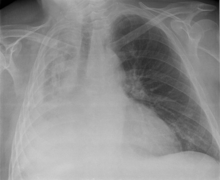 Atelectasia pulmonar