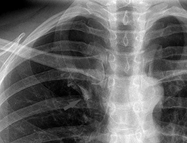 Detalle de una radiografía de tórax con una línea curva fina en el vértice pulmonar derecho, la cisura de la ácigos, que termina en la vena ácigos en forma de lágrima.