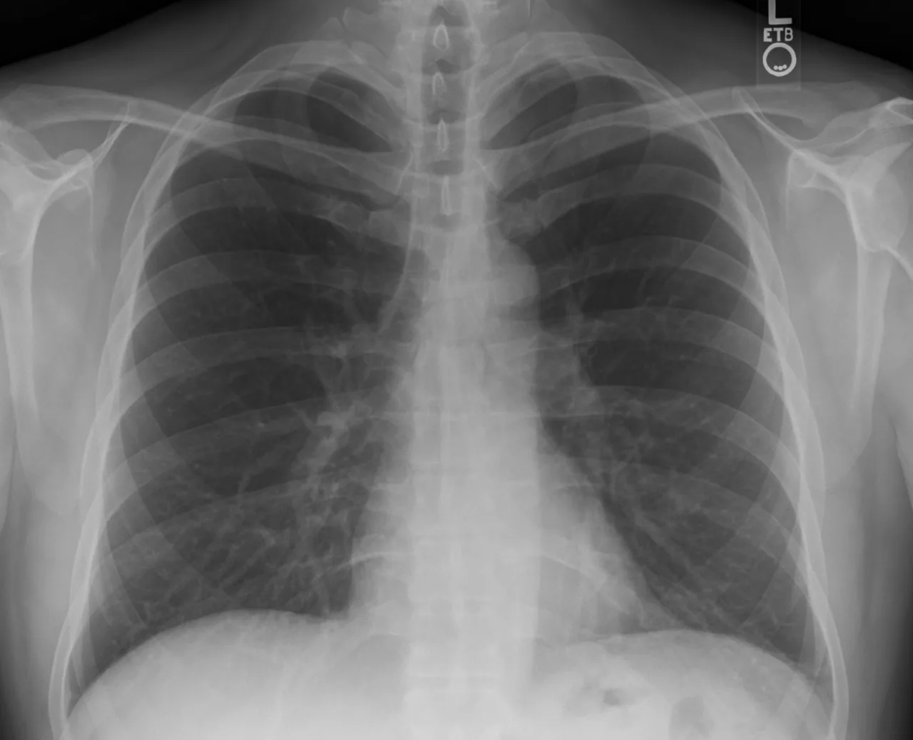 Radiografía de tórax normal (posteroanterior)