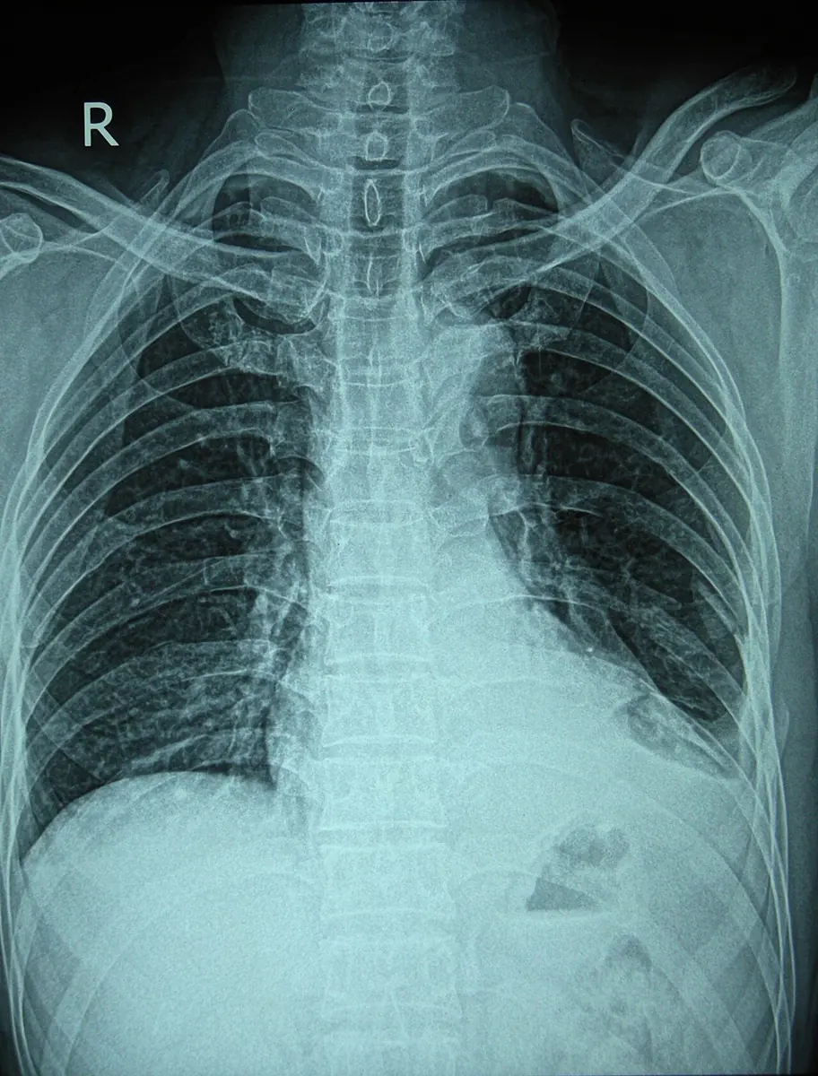 Radiografía posteroanterior de tórax de un hombre de 54 años con fracturas de varios arcos costales.