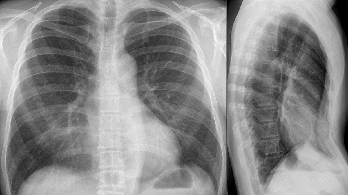 Radiografías de tórax posteroanterior y lateral con el corazón desplazado a la izquierda y el diámetro anteroposterior reducido por el hundimiento del esternón.