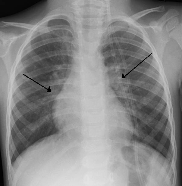 Bronquiolitis aguda del lactante