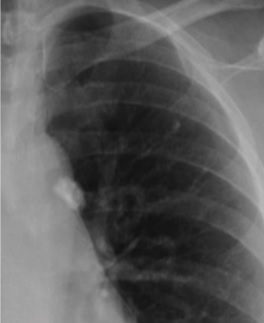 Tuberculosis primaria