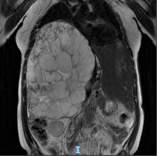 Hemangioma hepático