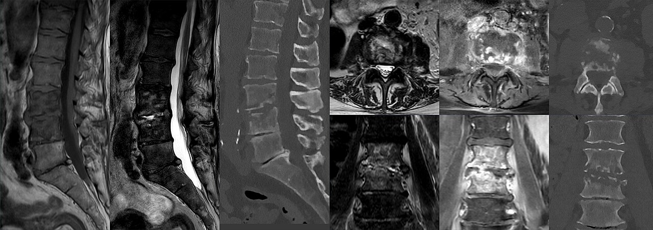 Espondilodiscitis infecciosa