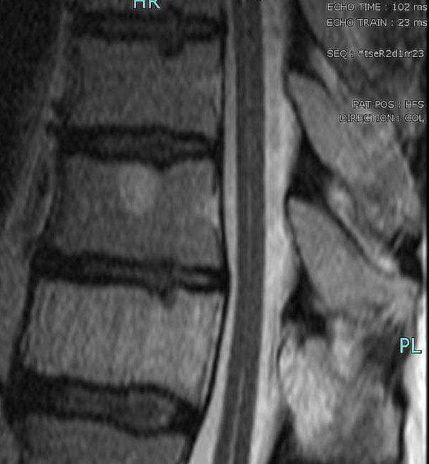 Hemangioma vertebral