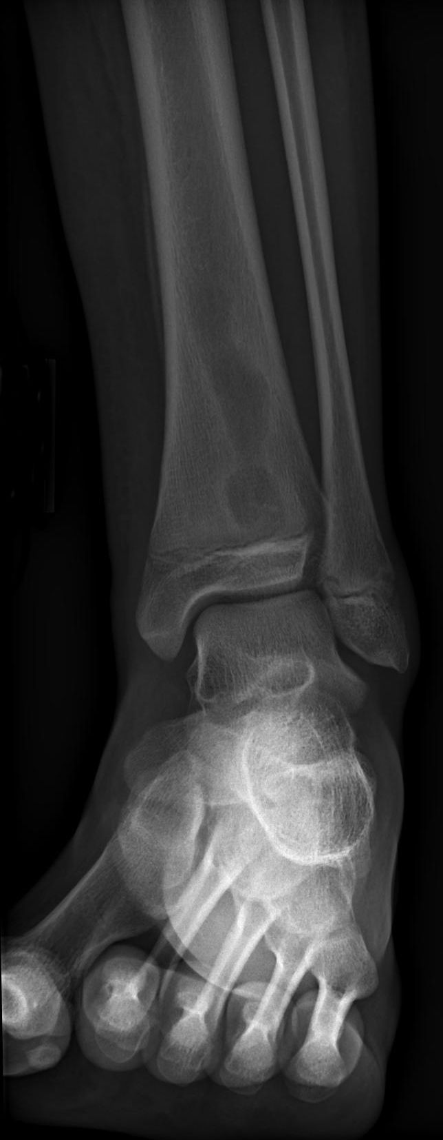 Osteomielitis