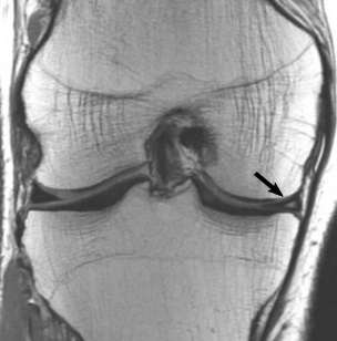 Rotura meniscal