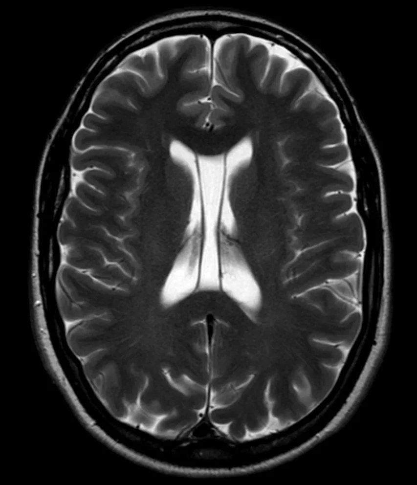 Resonancia axial T2 con una cavidad de líquido entre las dos hojas del septum pellucidum, que se prolonga hacia atrás como cavum vergae.