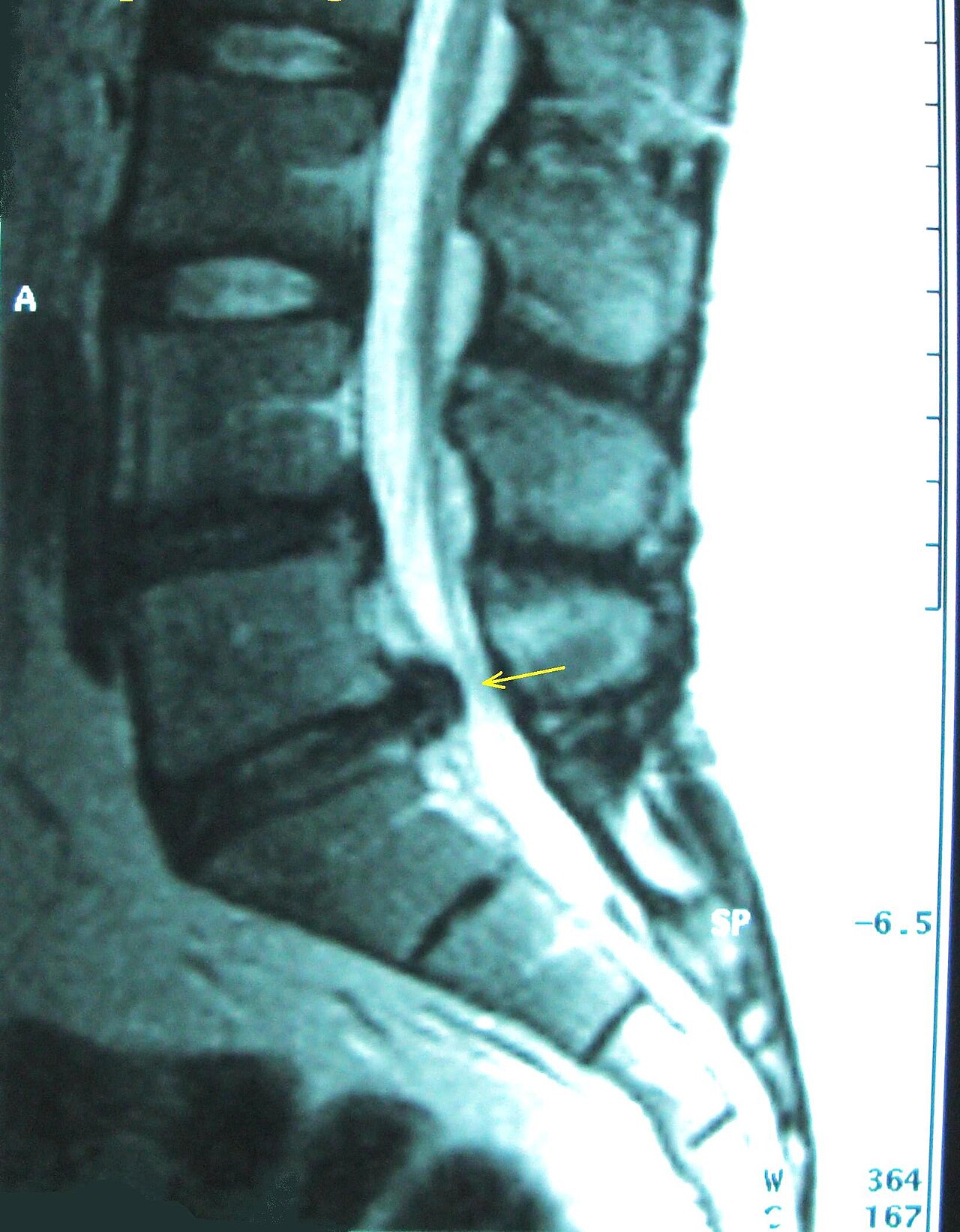 Hernia discal lumbar