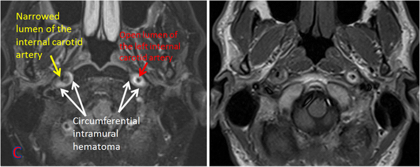 Disección arterial cervical
