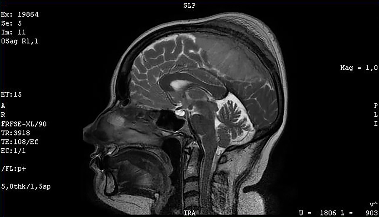 Meningioma