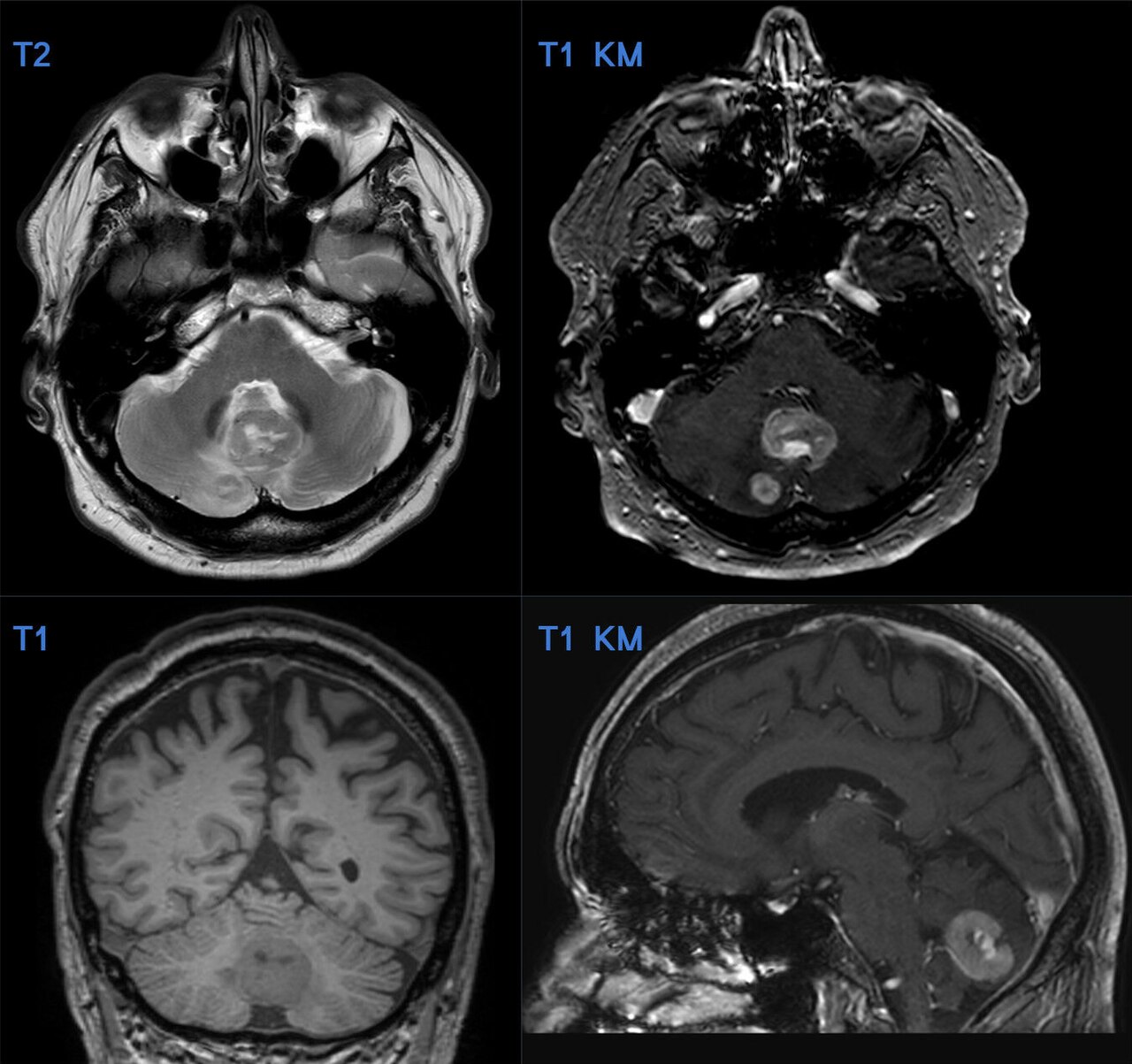 Metástasis cerebrales