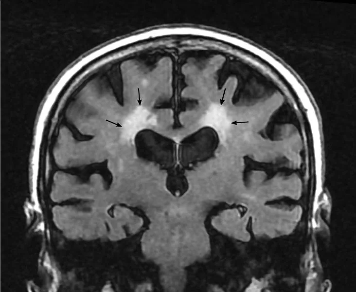 Resonancia coronal FLAIR de un paciente de 90 años con hiperintensidades confluentes de la sustancia blanca periventricular (flechas) y atrofia cerebral.