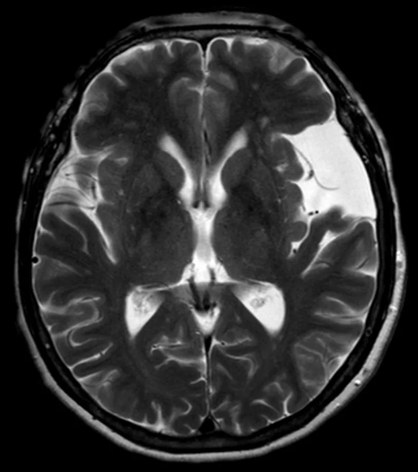 Resonancia axial T2 con una colección extraaxial de señal igual al líquido cefalorraquídeo en la fosa temporal izquierda, que desplaza el parénquima sin edema.