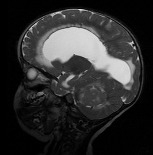 Meduloblastoma