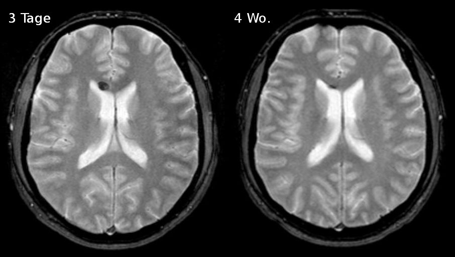 Lesión axonal difusa